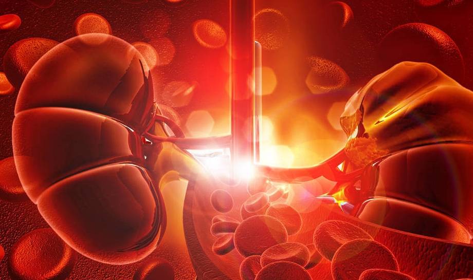 症状|缺血性肾病可发生慢性肾衰竭、血压升高,5大症状别忽视