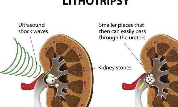 症状|被查出来有肾结石，该怎么办？这3个“对策”总会有用