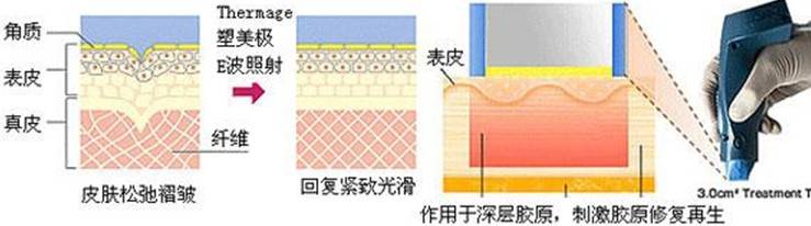 玛吉测评：热提拉和热玛吉哪个好、有什么区别？经验讲述!