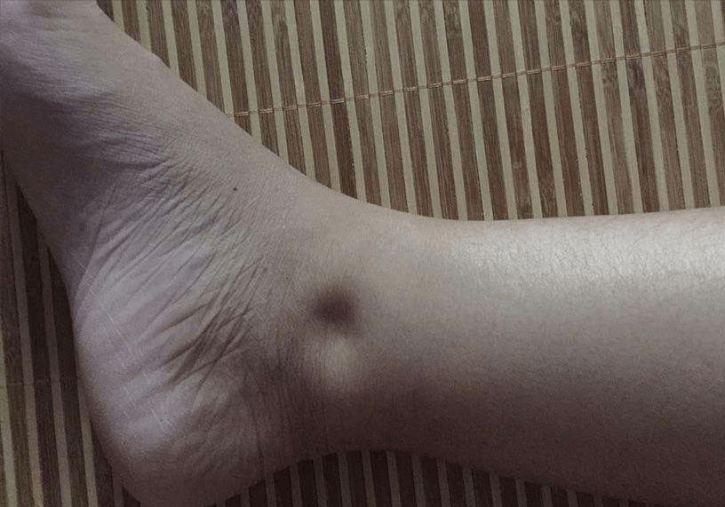 人群|冬季肾病高发复发原因有哪些?肾病年轻化明显,哪些人是高危人群