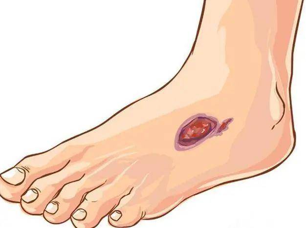 足部|如何防治糖尿病足 刘文华院长：“三防一治”可无忧