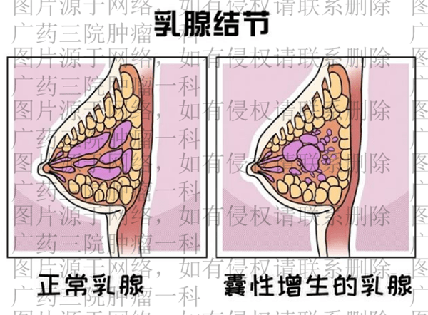 在我国的检查中,乳腺钼靶是最早用于乳腺癌筛查和诊断的检查之一,是