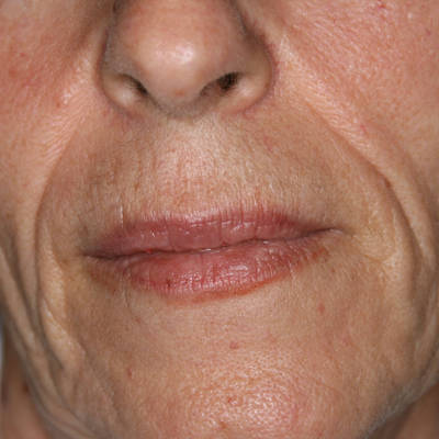 原创小拉皮除皱术效果怎么样?