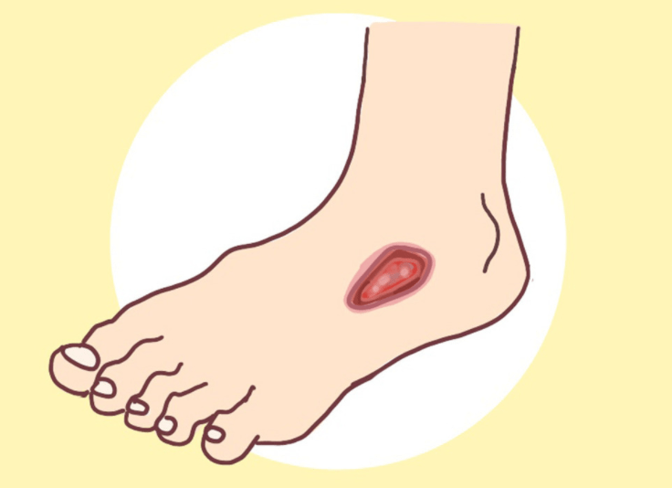 并发症|联合国糖尿病日 | 附超实用糖尿病患者忌口大全,收藏!