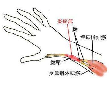 抱孩子手腕疼怎么办