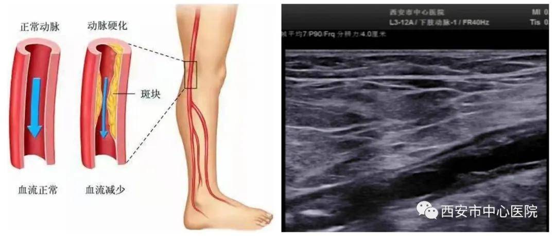 医学科|这帮彩超医师为了糖友，也是拼了！