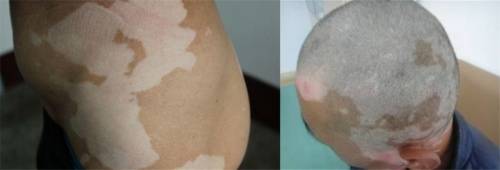 免疫|合肥华夏白癜风皮肤病医院：解读微量元素与白癜风的关系