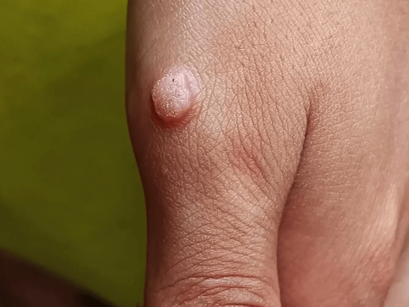 女子手上长了几个"包",查出hpv感染,医生:hpv的危害可远远不止宫颈