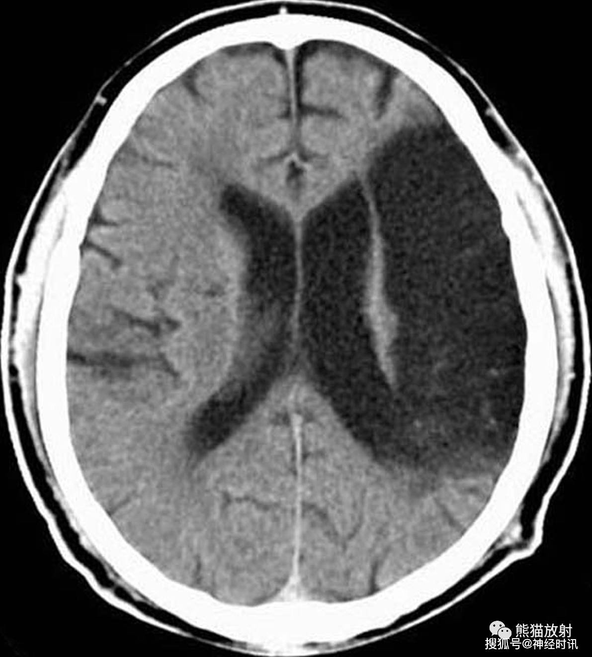 顳葉,基底節區大片腦梗死左側大腦半球腦梗死左