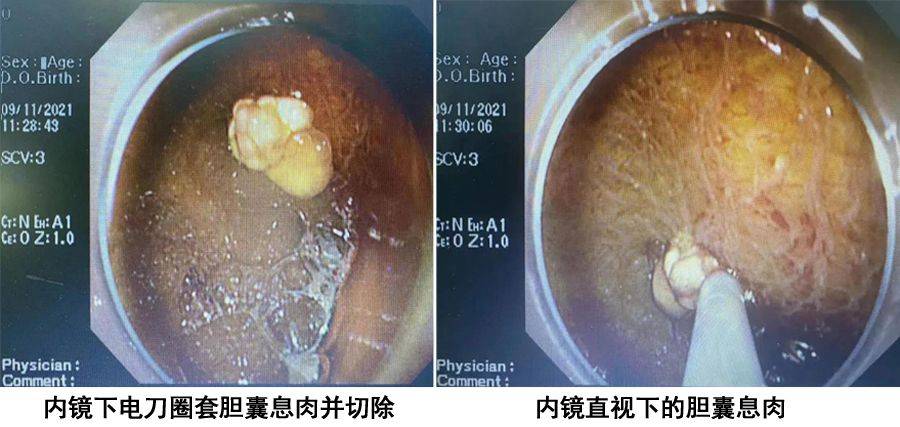 胆囊息肉微创手术图片图片