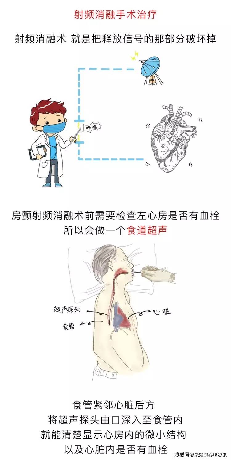 房颤|你了解房颤吗?一文图解掌握