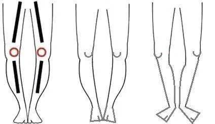 o型腿(膝內翻)分體分級和康復訓練