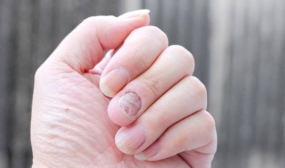 【灰指甲】灰指甲发病原因_灰指甲的预防与护理