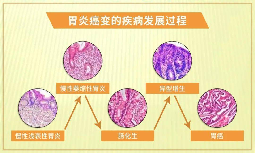 萎縮性胃炎腸上皮化生意味著什麼千萬別大意這是胃癌前病變