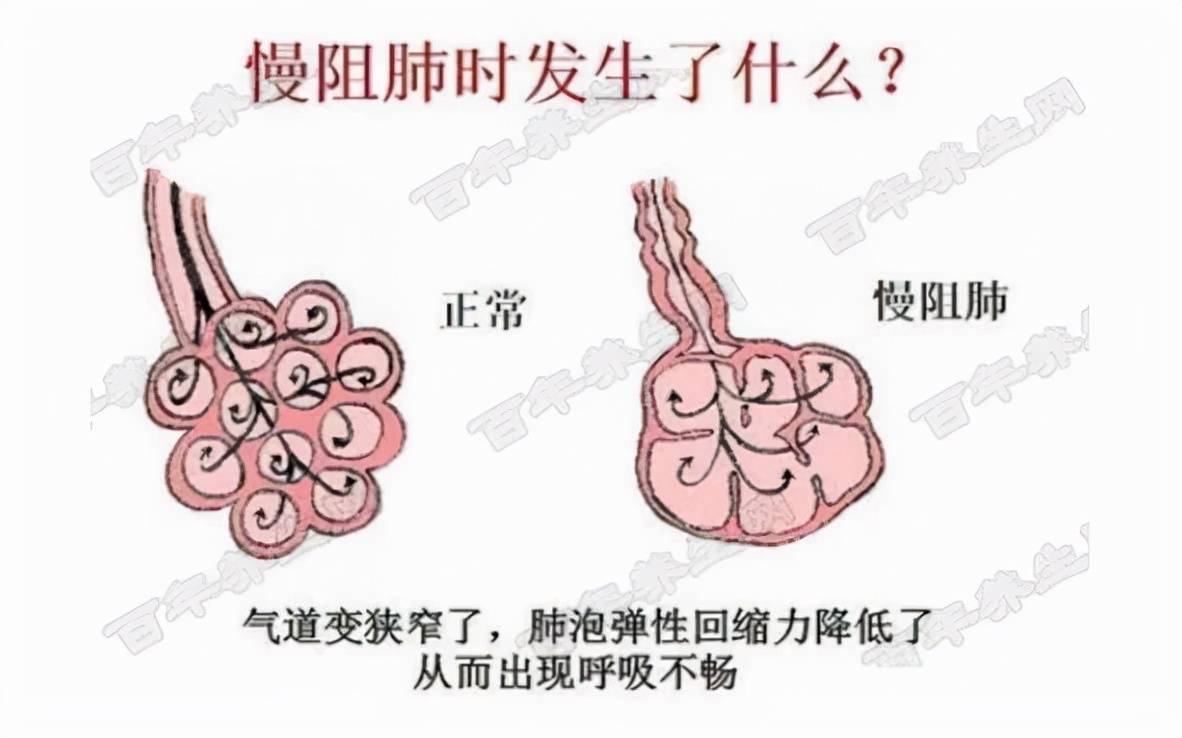 症状|走进你还不了解的慢阻肺