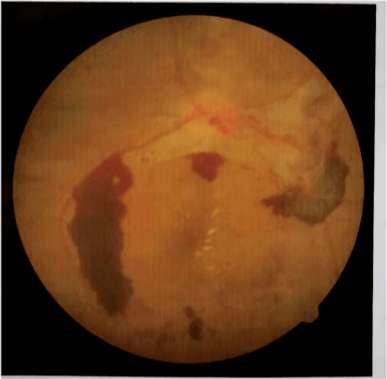 血管|糖尿病可能发生的并发症