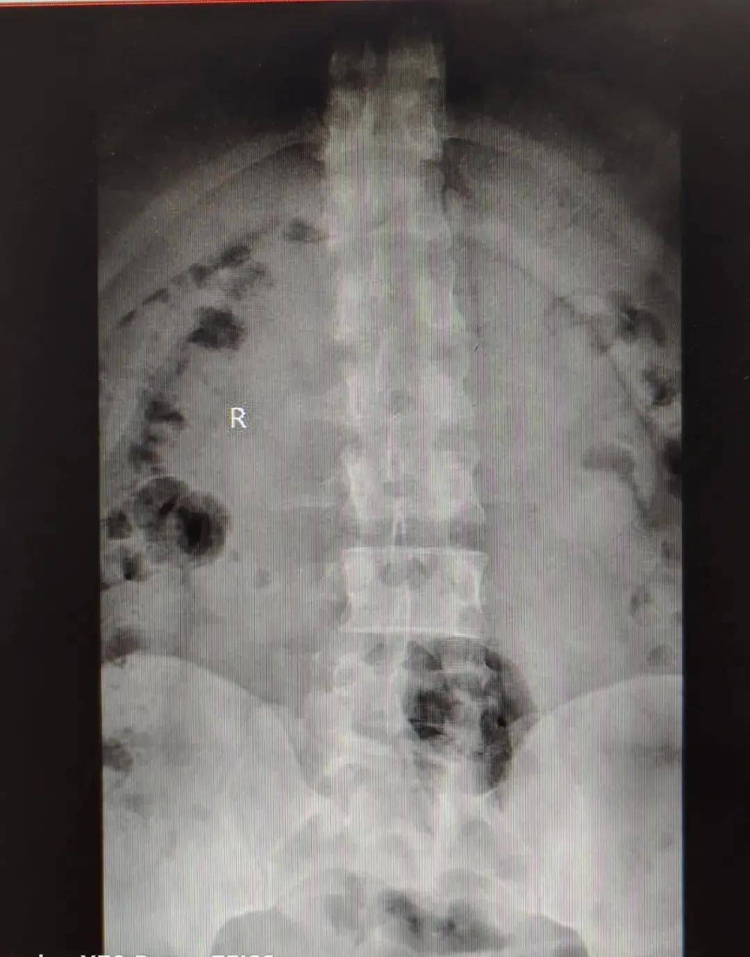 关节|影像检查｜DR&amp; CT&amp; MRI，在椎间盘疾病中如何选择呢？