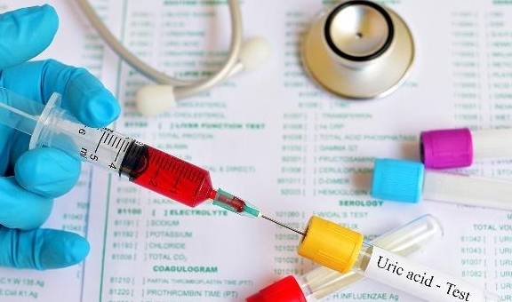 症状|高尿酸患者,身体若有3个“变化”,可能是肾衰竭早期信号