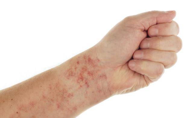 症状|帮你揪出紫癜的3大“元凶”，想要预防紫癜，要坚持做好这几件事