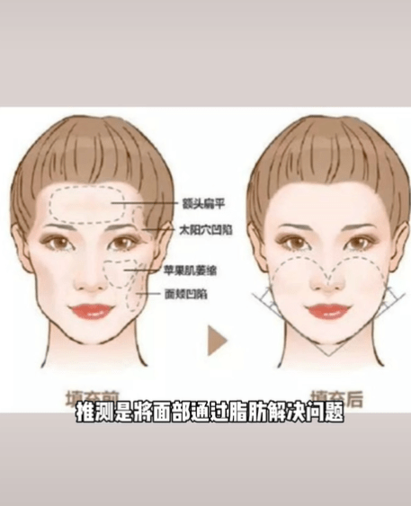分析鞠婧祎被质疑整容！医美博主称其是硅胶隆鼻填充脂肪最成功案例