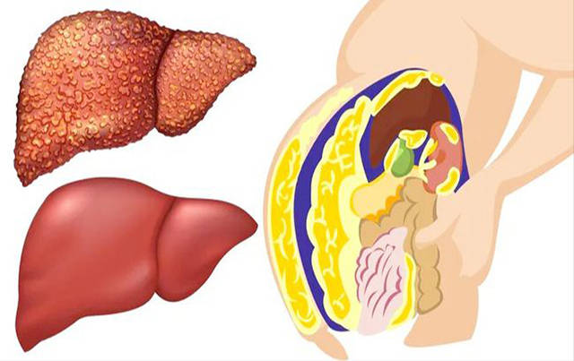 導致正常肝小葉結構破壞和肝內循環障礙為特點的常見慢性肝bing