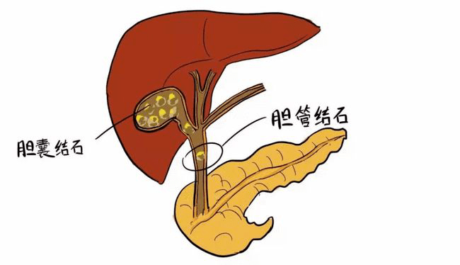 膽囊及膽管疾病,如膽囊結石,膽囊息肉,膽囊炎變,膽管結石,膽囊癌與