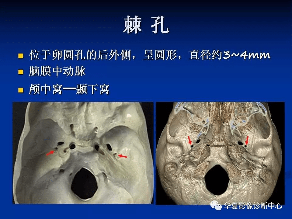 圆孔卵圆孔棘孔解剖图图片