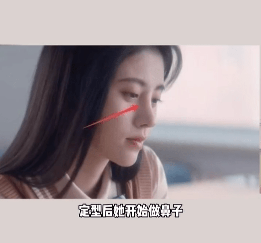 分析鞠婧祎被质疑整容！医美博主称其是硅胶隆鼻填充脂肪最成功案例
