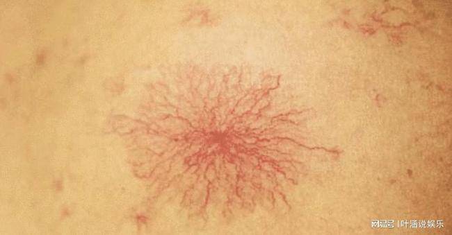 20岁大学生肝癌离世医生叹息1面条天天吃无异自毁肝脏