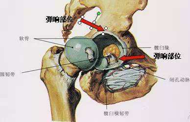 生命汇整合国际医疗提醒:髋关节弹响需要被重视吗?_综合征_时会_损伤