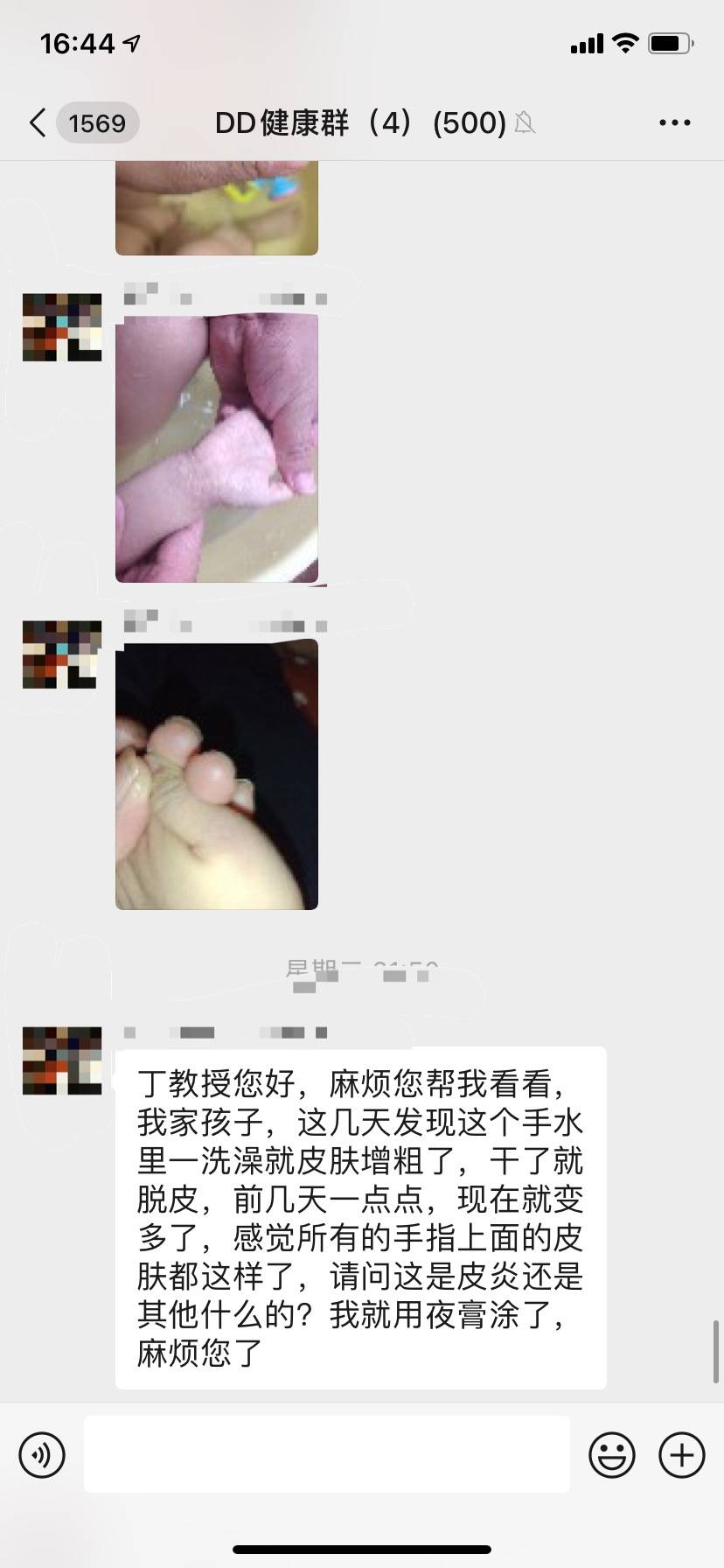 软膏仿生护理软膏：孩子的手一洗澡就会皮肤增粗了，应该如何改善？