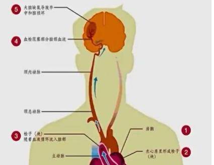 心脏|陈大爷心慌一个月，没有重视，结果中风偏瘫半身不遂！为什么？