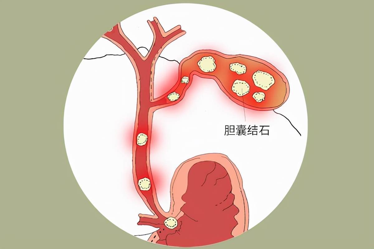 胆囊息肉,饮食要注意什么?