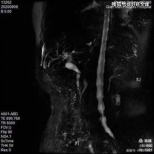 結石胸部ct平掃-肺癌上腹部ct平掃-肝癌骨盆三維重建-右側髖臼前柱及