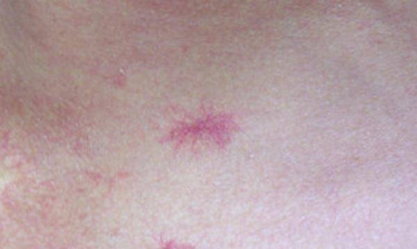 治疗|得乙肝20多年，肝脏没硬化，他所用的护理方法，医生表示认可