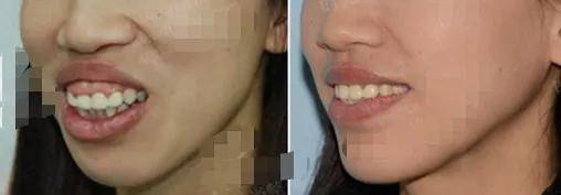 宋轶凸嘴无法修复的四种迹象,千万别中招