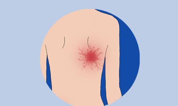 进行|肝硬化是“哑巴病”？身体早就给出警告，别一再错过