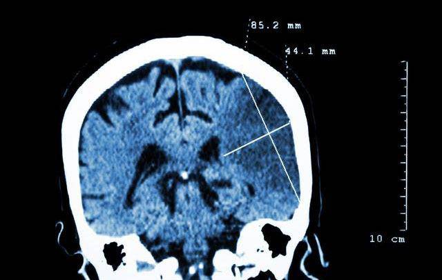 血管|高血压患者多久查一次头CT？医生说：还要看心、肾、血管、眼睛