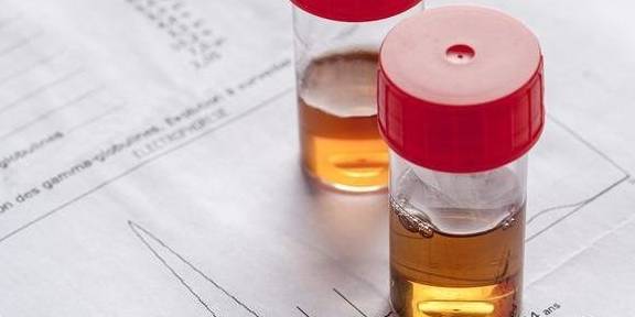 肾脏|长期泡沫尿，并且潜血+++，怎么办？小克告诉你