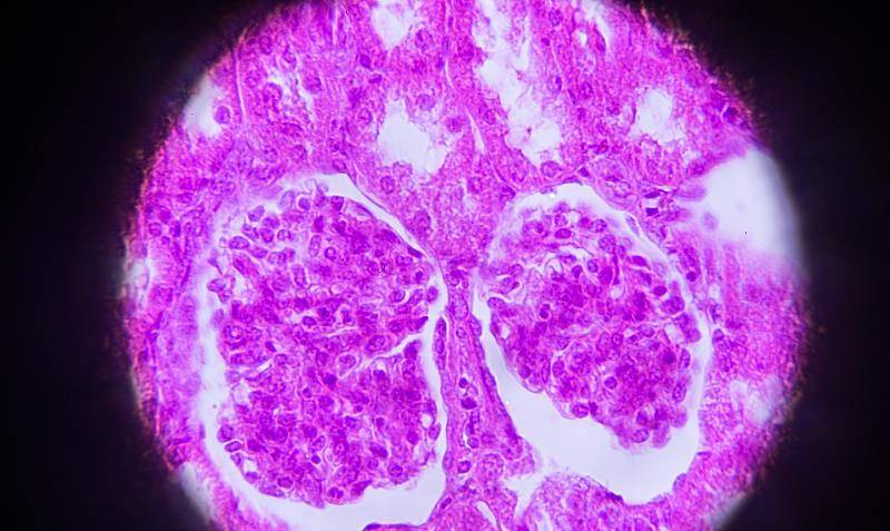 症状|过敏性紫癜未阐明病因,要与5大疾病区分,并发症检查也不能忽视