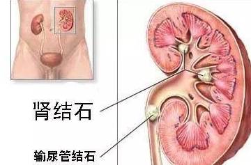 物质|它们是诱发肾结石的“罪魁祸首”，若不想疾病缠身，尽量远离！