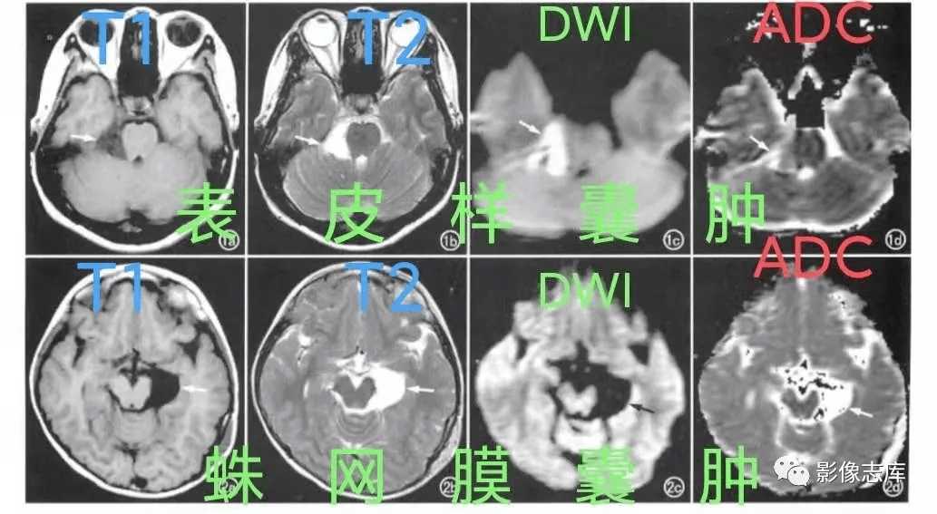 表皮樣囊腫和蛛網膜囊腫具有相同的t1和t2特點dwi應如何鑑別
