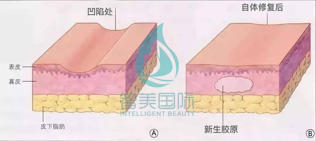 微创面智美国际剥离术：岁月不能败美人 拒绝印第安纹拉低颜值