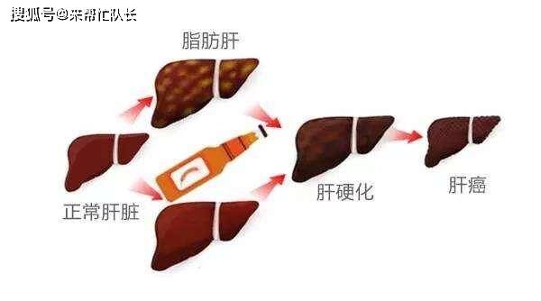 症状|食欲不振、消瘦、肚子却莫名变大，发现肝腹水还能活多久？