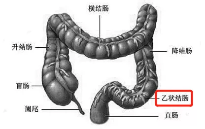 67廣藥三院微創下的乙狀結腸癌