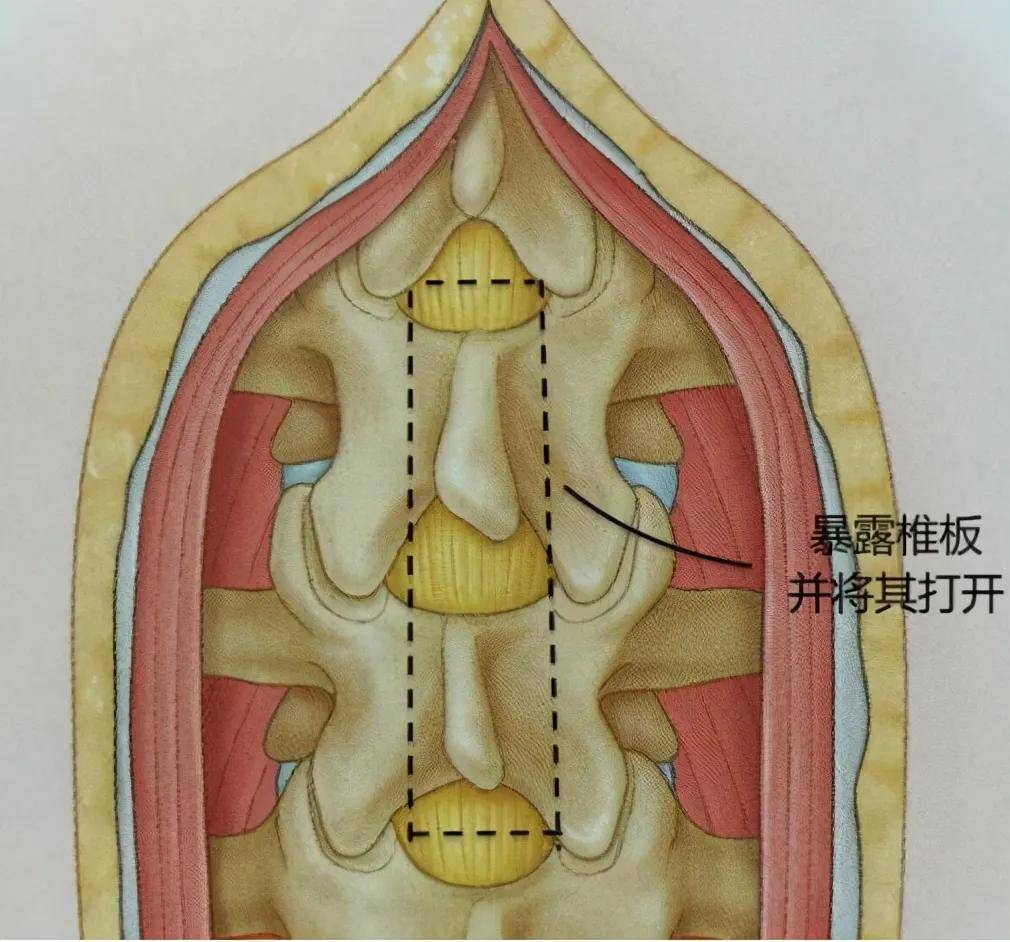 障碍|走路像“踩高跷” 当心肿瘤在“敲门”