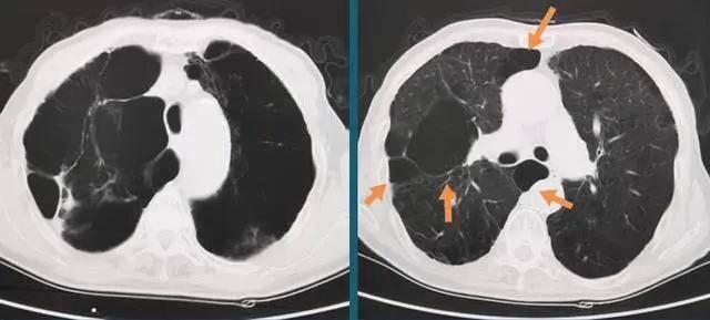 肺大泡怎么办啊