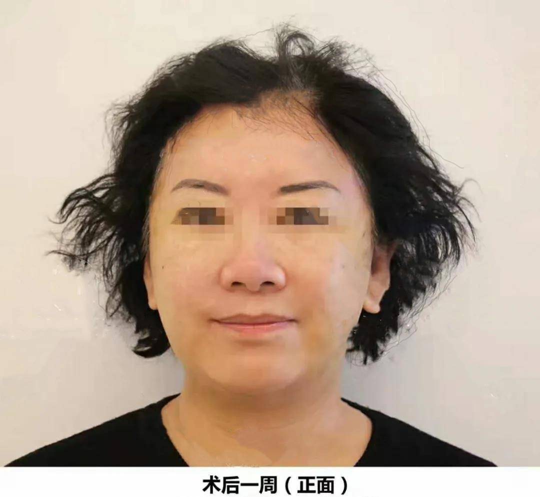 大姐60岁大姐面部提升真实经历：术后10天换脸实拍，为了美她也是拼了