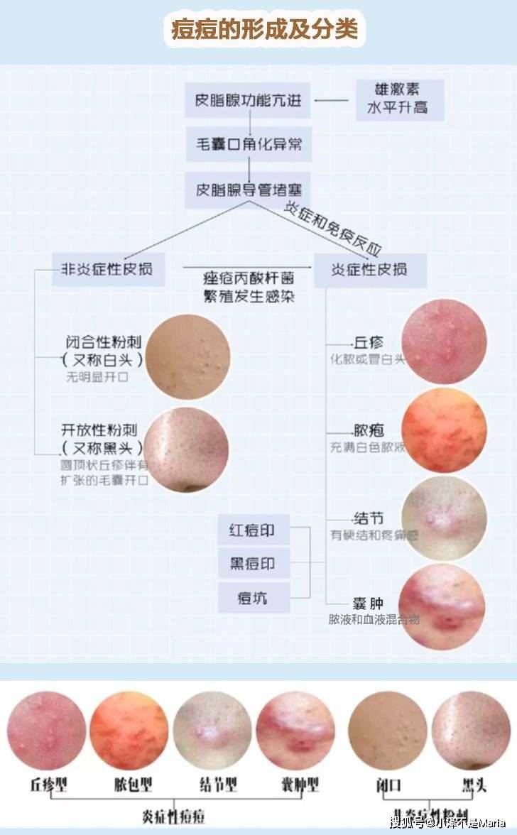 脸部别再用手挤痘痘了，痘痘肌的护肤经验今天我都帮你总结全了！