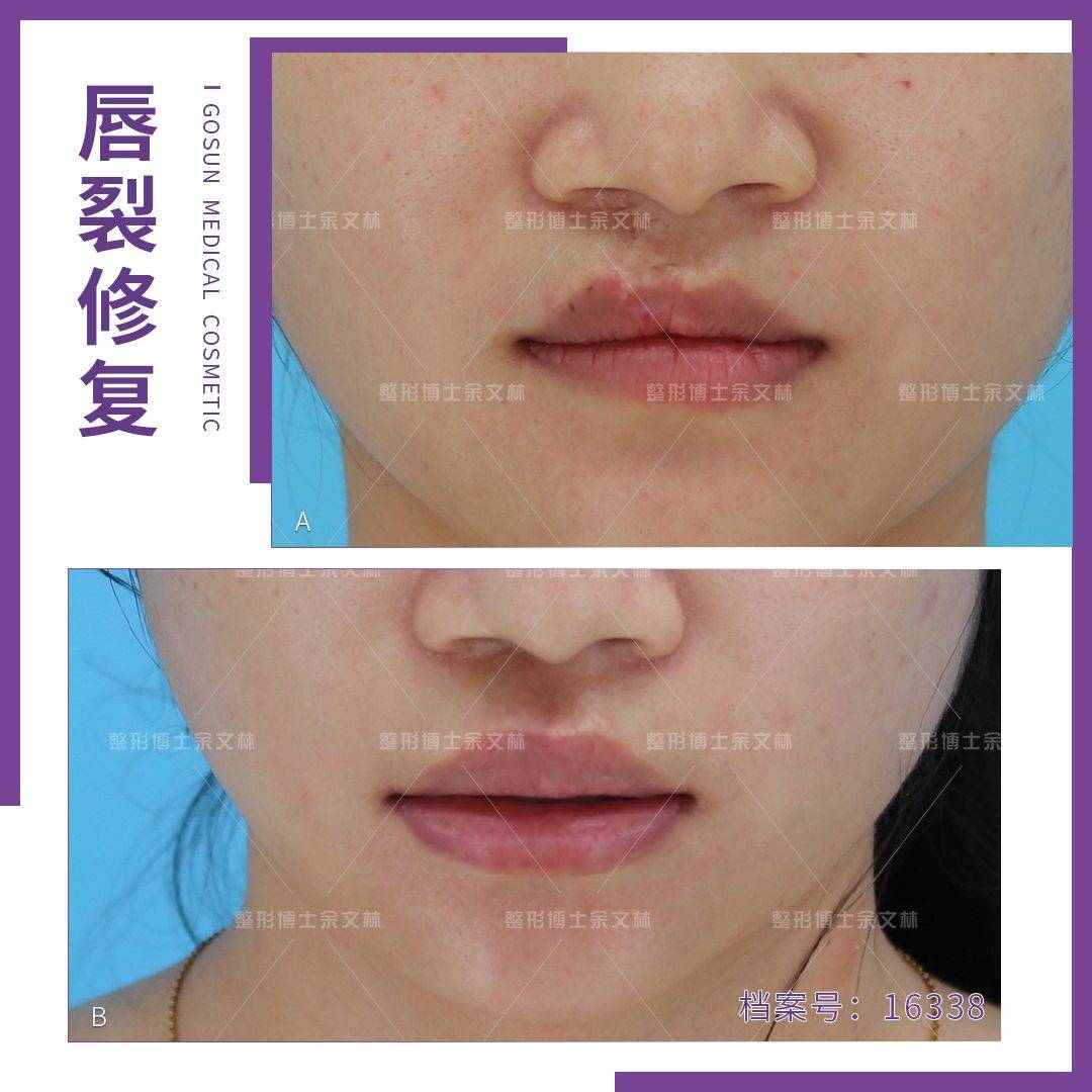 成形术唇裂继发红唇畸形修复，要恢复正常的形态容易吗？